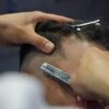AGAの年齢別薄毛の特徴を示す頭髪の画像